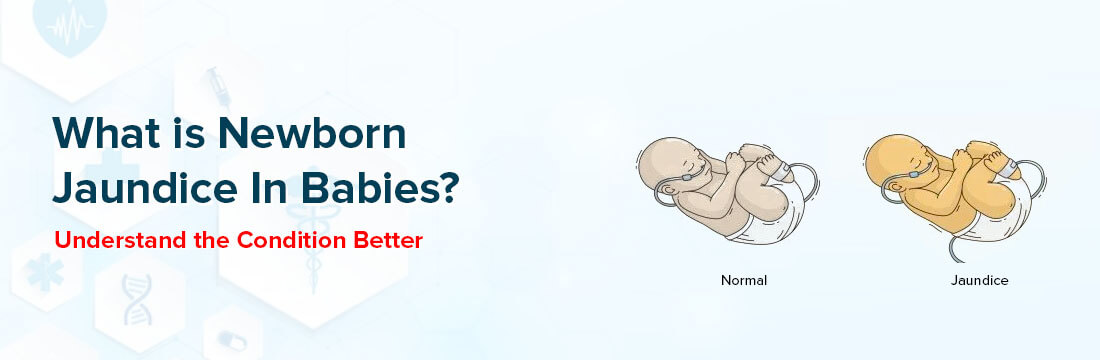 What Is Newborn Jaundice In Babies? Understand the Condition Better